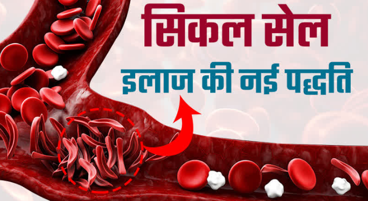 धमधा में सिकल सेल रोगियों के लिए दिव्यांगता प्रमाण पत्र हेतु स्वास्थ्य शिविर का आयोजन